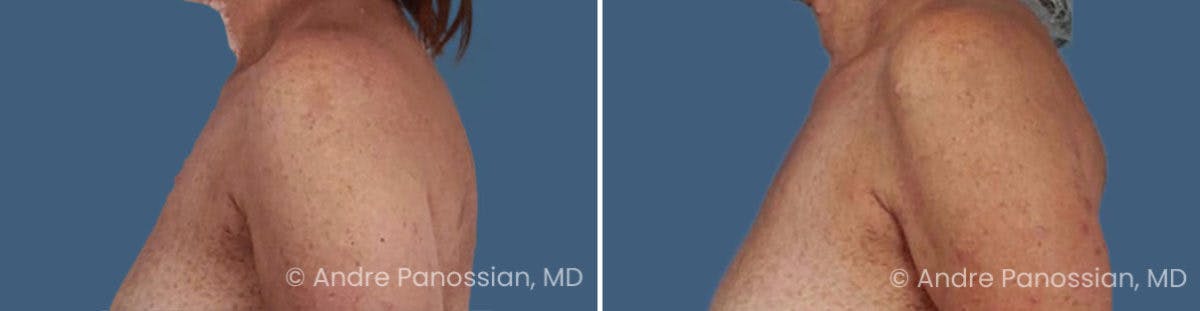 Neurofibromatosis Before & After Gallery - Patient 151400 - Image 2