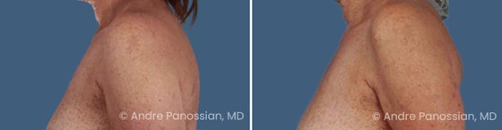 Neurofibroma removal & reconstruction before and after — actual patient of Andre Panossian, MD