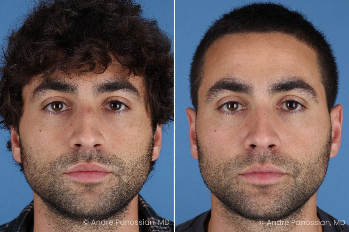 Rhinoplasty Before & After Gallery - Patient 122250 - Image 2