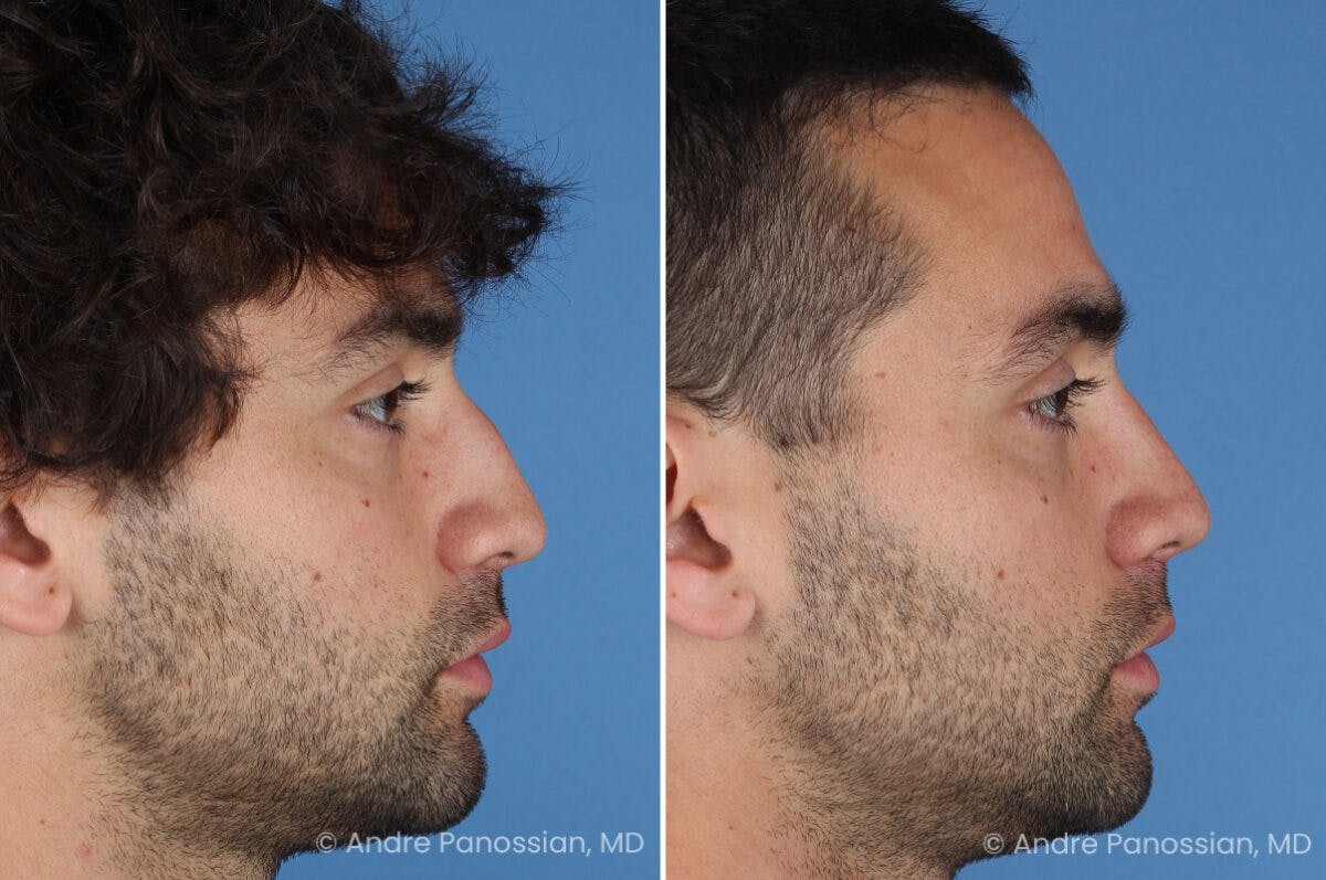 Rhinoplasty Before & After Gallery - Patient 122250 - Image 3