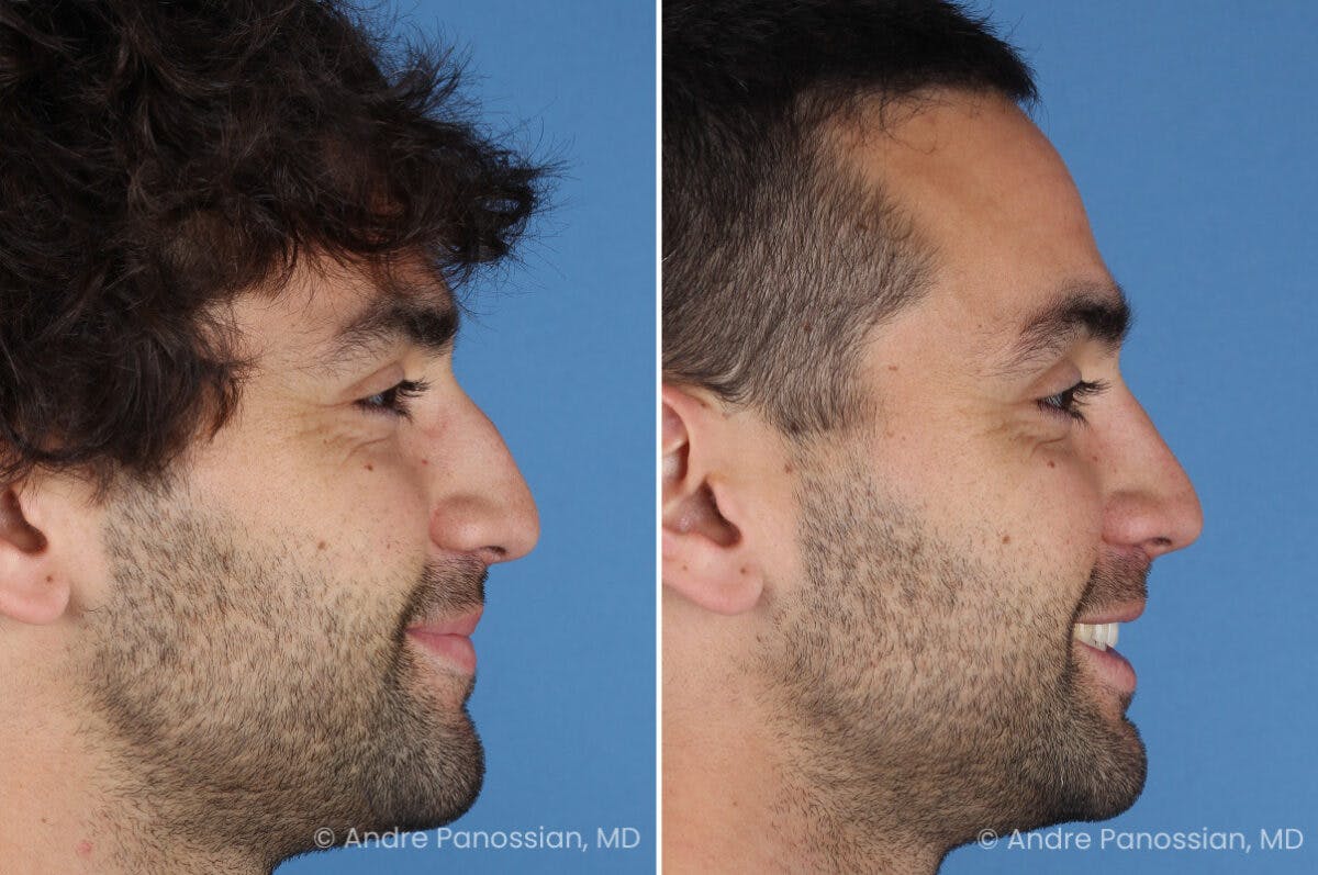 Rhinoplasty Before & After Gallery - Patient 122250 - Image 1