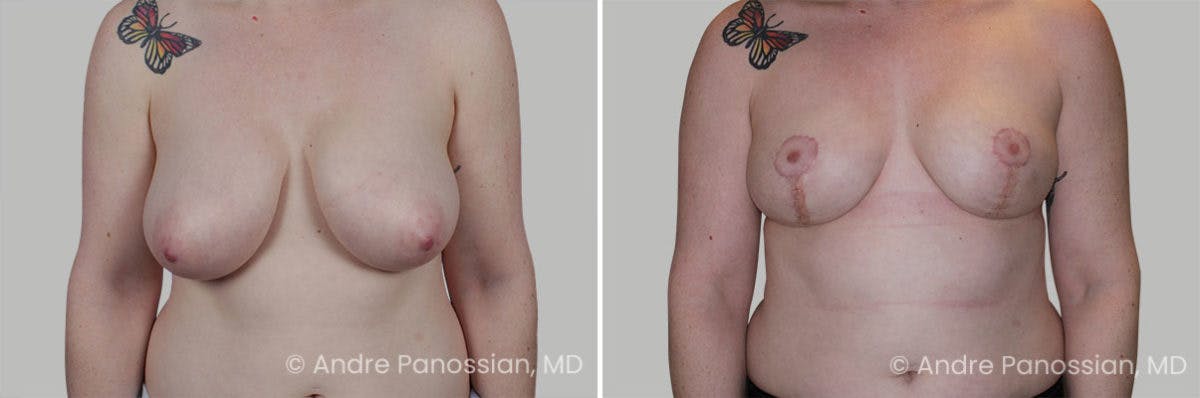 Breast Lift/Reduction Before & After Gallery - Patient 266831 - Image 1