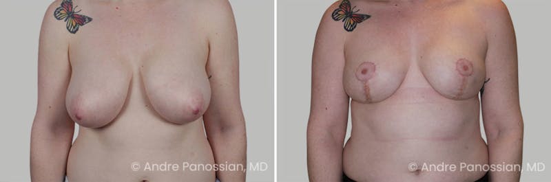 Breast Lift/Reduction Before & After Gallery - Patient 266831 - Image 1