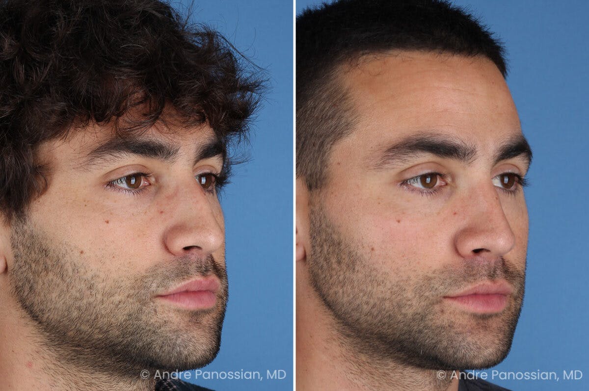Rhinoplasty Before & After Gallery - Patient 122250 - Image 4