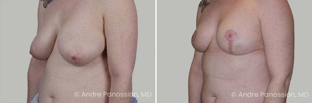 Breast Lift/Reduction Before & After Gallery - Patient 266831 - Image 2
