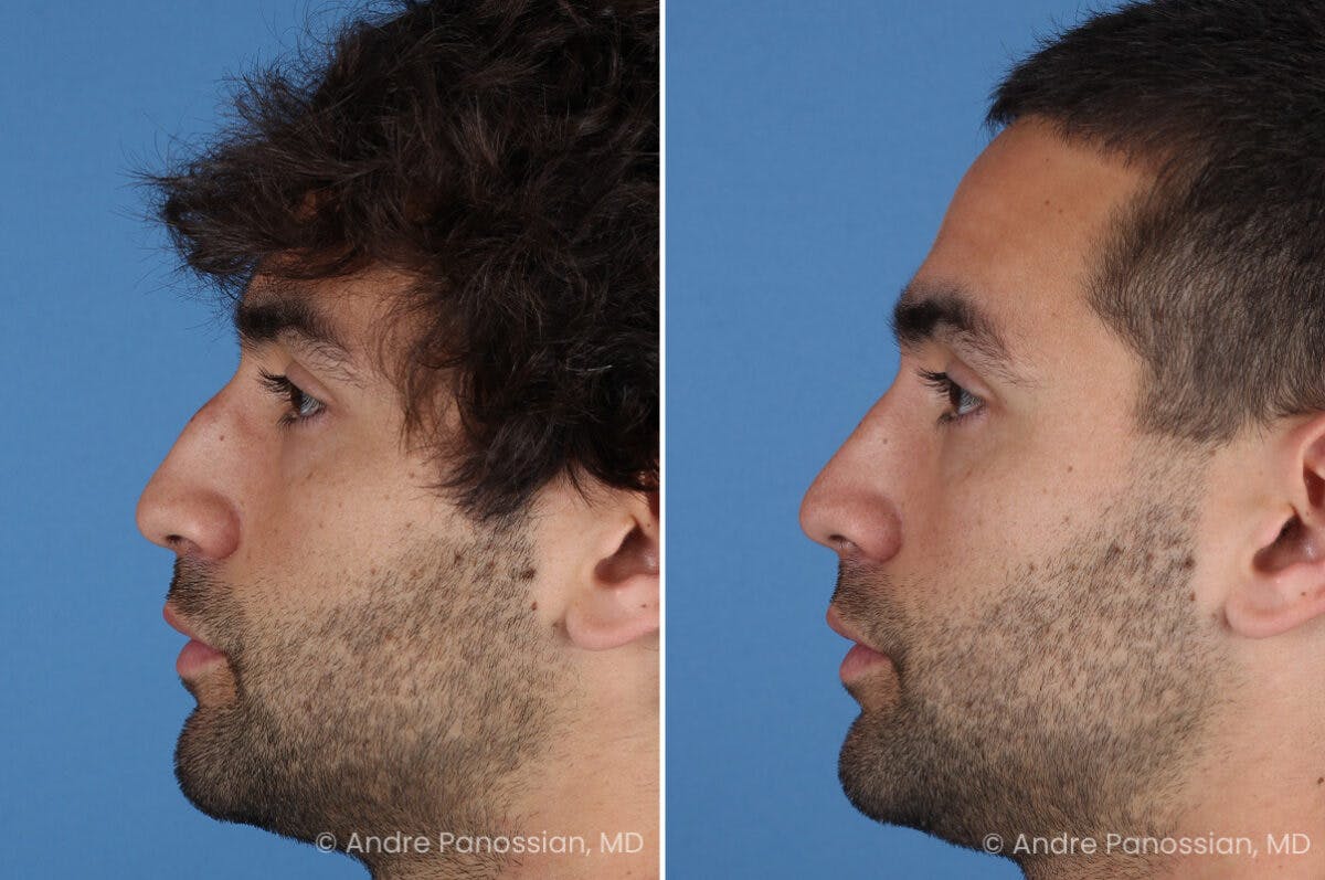 Rhinoplasty Before & After Gallery - Patient 122250 - Image 5