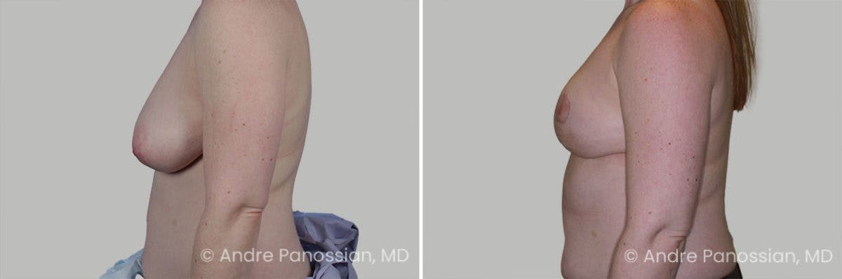 Breast Lift/Reduction Before & After Gallery - Patient 266831 - Image 3