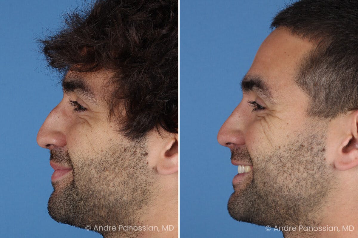 Rhinoplasty Before & After Gallery - Patient 122250 - Image 6
