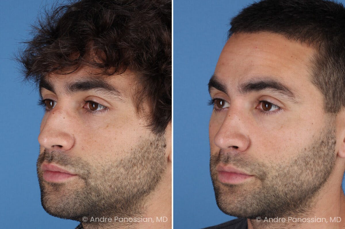 Rhinoplasty Before & After Gallery - Patient 122250 - Image 7