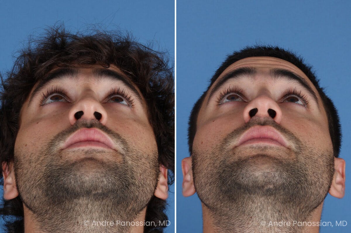 Rhinoplasty Before & After Gallery - Patient 122250 - Image 8