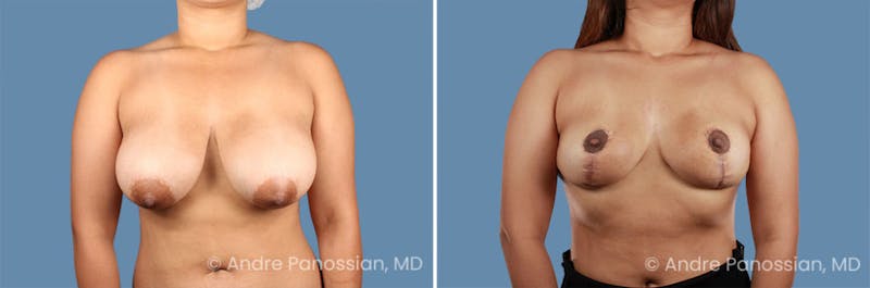 Breast Lift/Reduction Before & After Gallery - Patient 281906 - Image 1