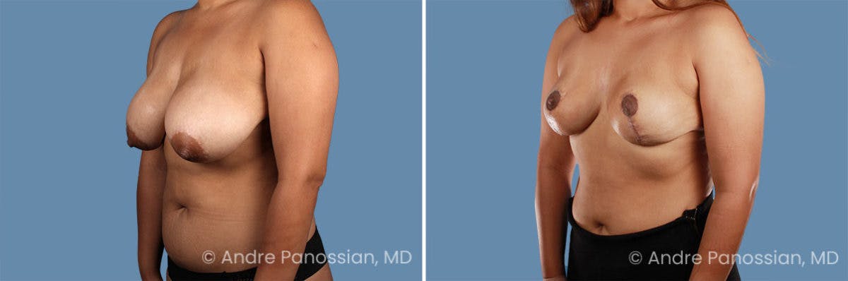 Breast Lift/Reduction Before & After Gallery - Patient 281906 - Image 2