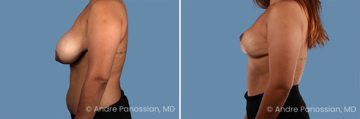 Breast Lift/Reduction Before & After Gallery - Patient 281906 - Image 3