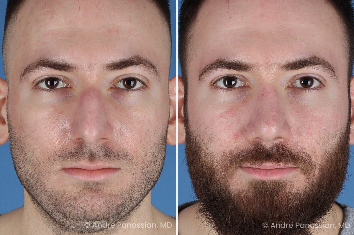 Rhinoplasty Before & After Gallery - Patient 971369 - Image 2