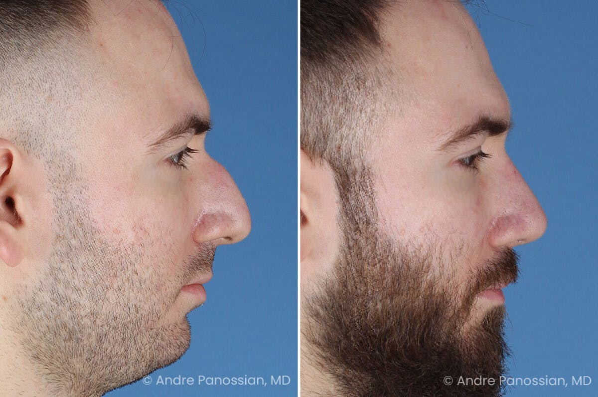 Rhinoplasty Before & After Gallery - Patient 971369 - Image 3