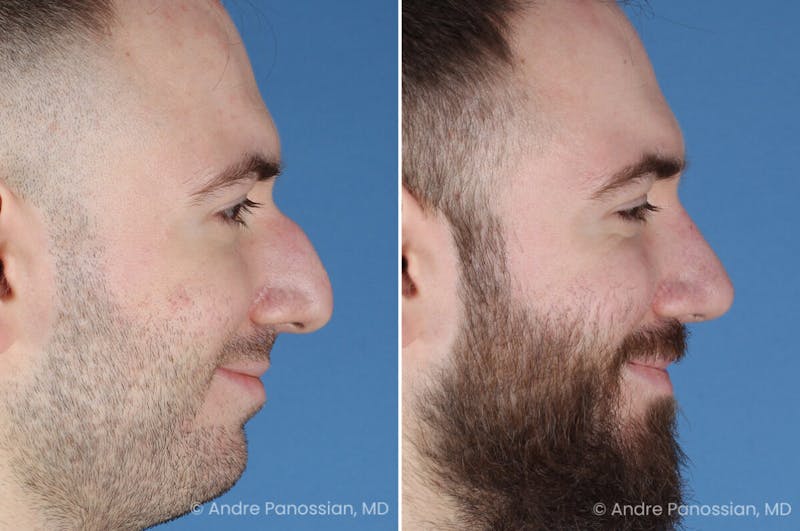 Rhinoplasty Before & After Gallery - Patient 971369 - Image 1
