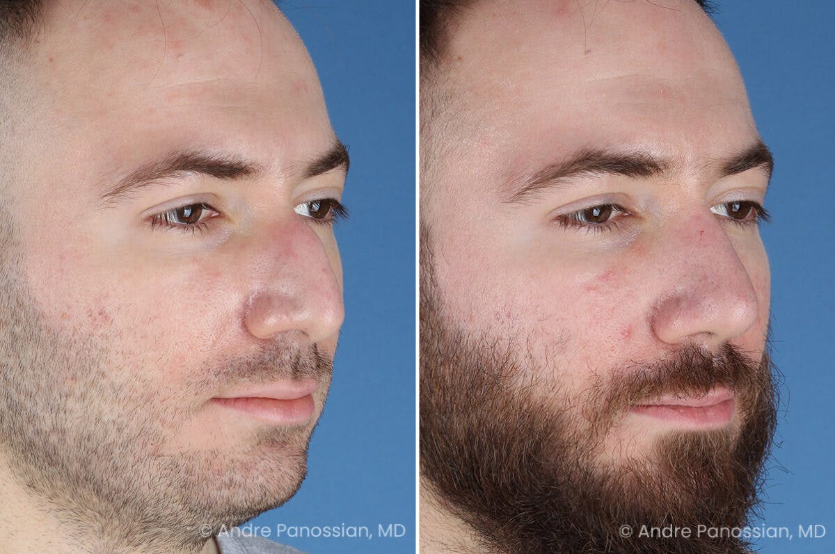 Rhinoplasty Before & After Gallery - Patient 971369 - Image 4