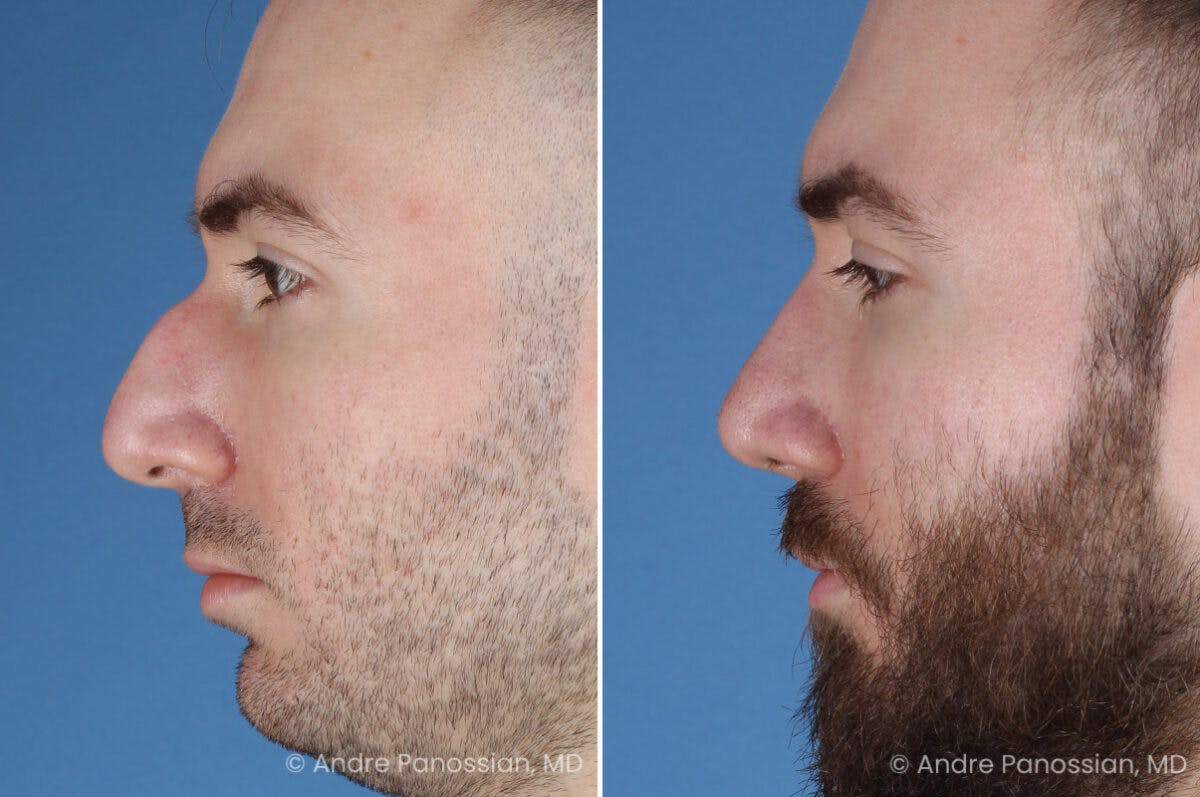 Rhinoplasty Before & After Gallery - Patient 971369 - Image 5