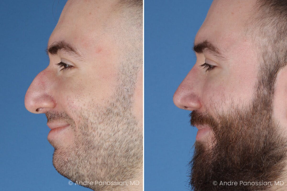 Rhinoplasty Before & After Gallery - Patient 971369 - Image 6