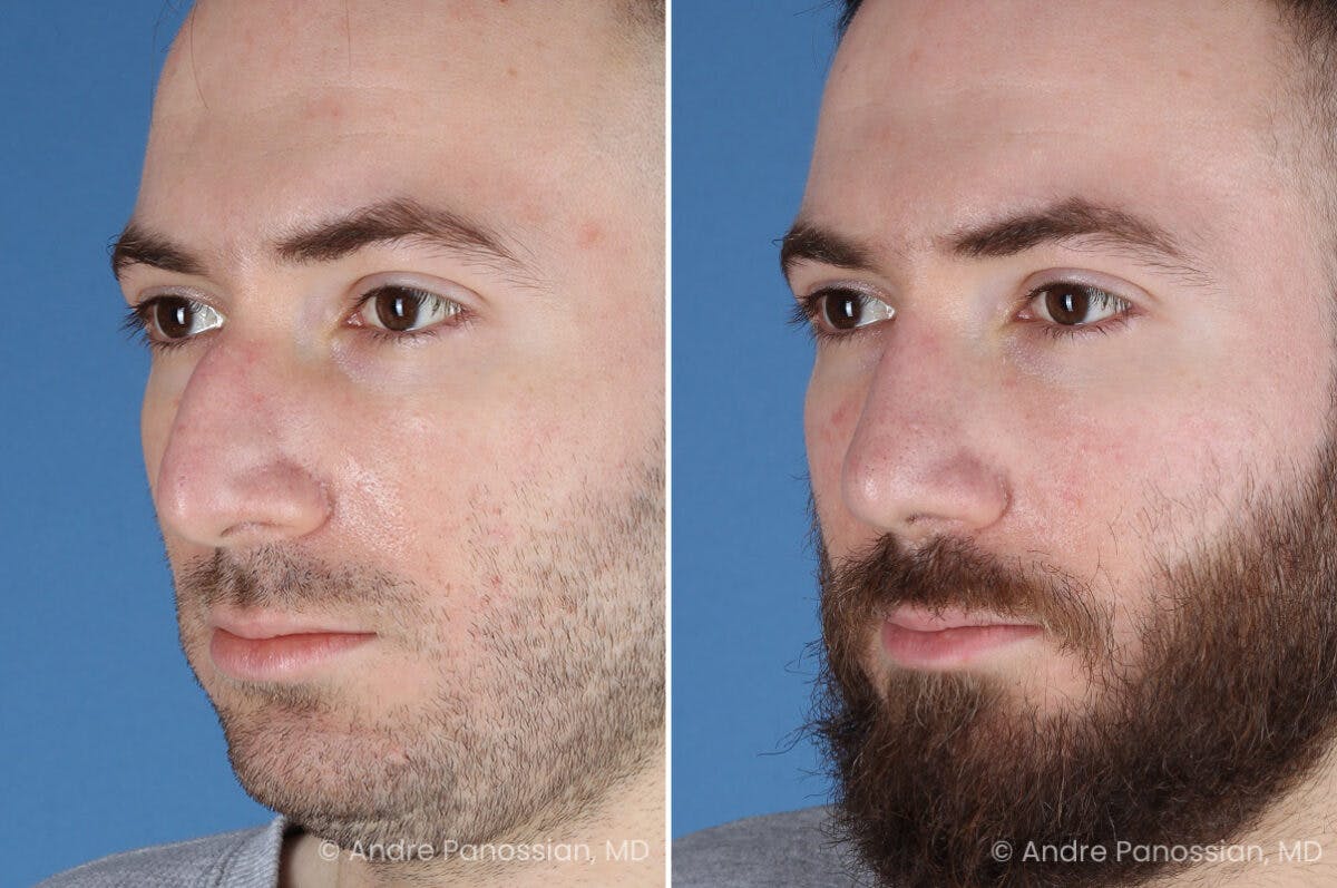 Rhinoplasty Before & After Gallery - Patient 971369 - Image 7