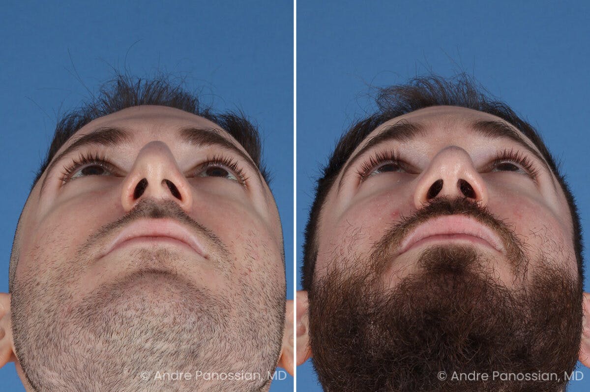 Rhinoplasty Before & After Gallery - Patient 971369 - Image 8