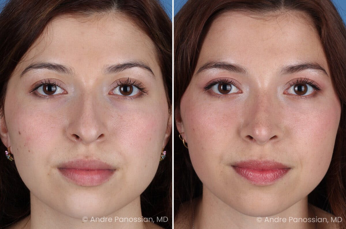 Rhinoplasty Before & After Gallery - Patient 866542 - Image 2