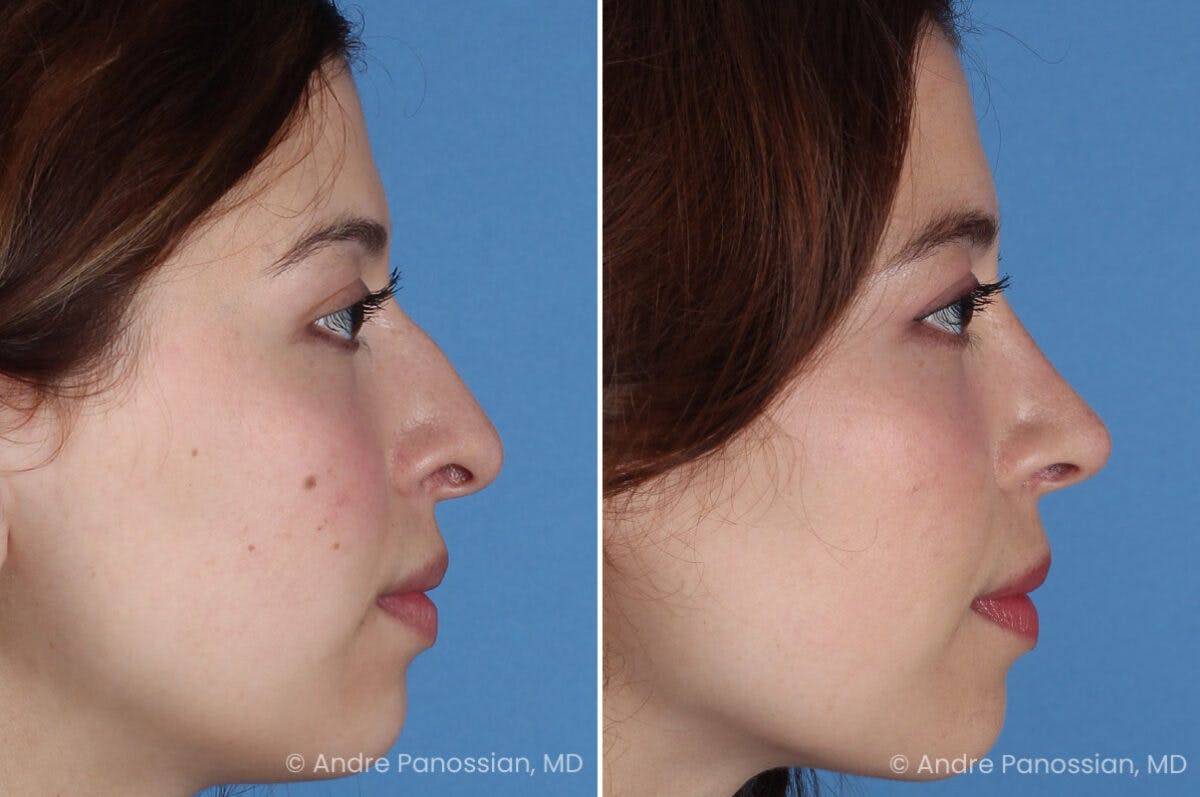 Rhinoplasty Before & After Gallery - Patient 866542 - Image 3