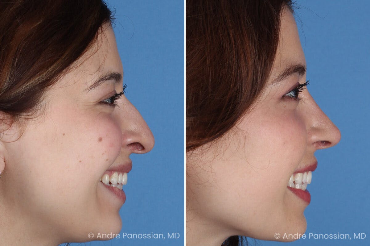 Rhinoplasty Before & After Gallery - Patient 866542 - Image 1