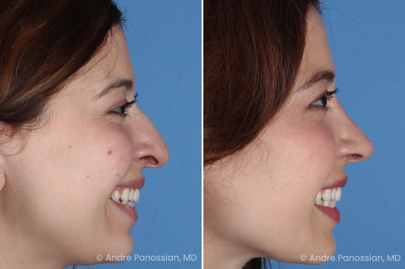 Rhinoplasty Before & After Gallery - Patient 866542 - Image 1