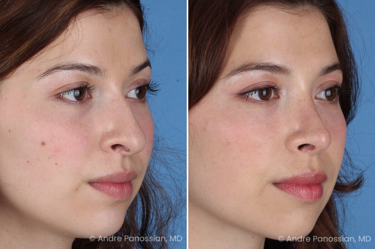 Rhinoplasty Before & After Gallery - Patient 866542 - Image 4