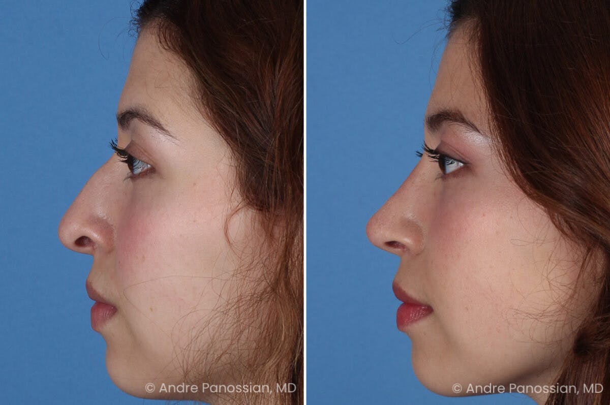 Rhinoplasty Before & After Gallery - Patient 866542 - Image 5