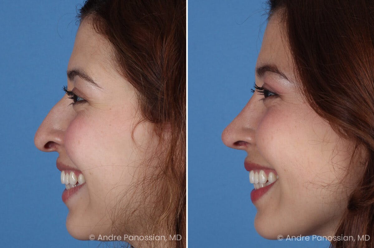 Rhinoplasty Before & After Gallery - Patient 866542 - Image 6