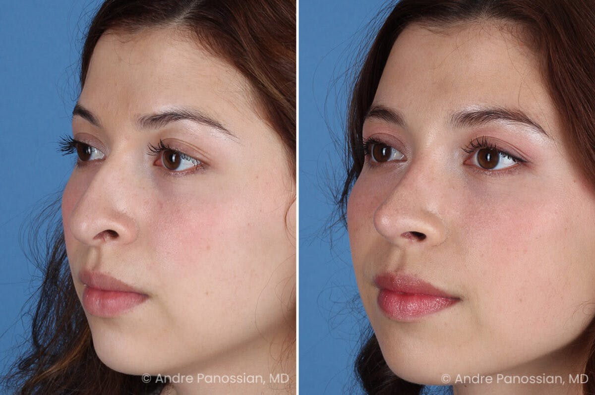 Rhinoplasty Before & After Gallery - Patient 866542 - Image 7