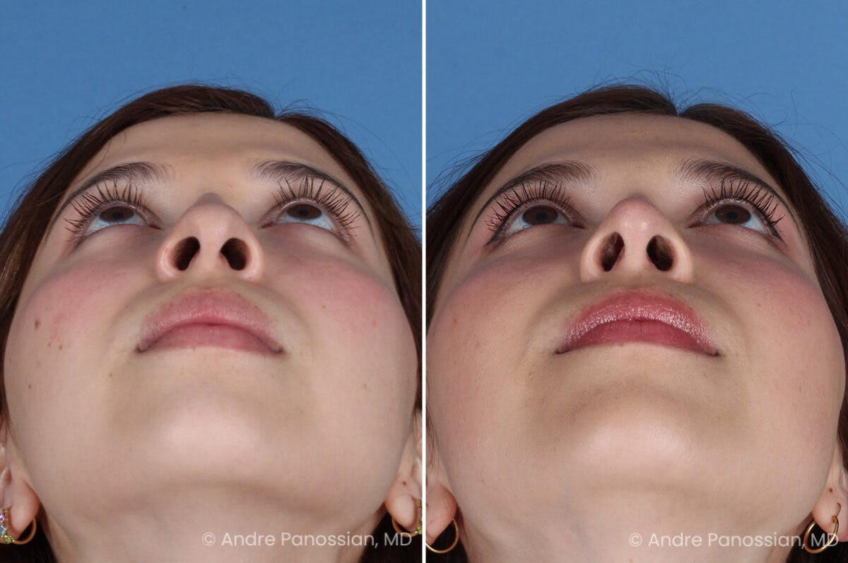 Rhinoplasty Before & After Gallery - Patient 866542 - Image 8