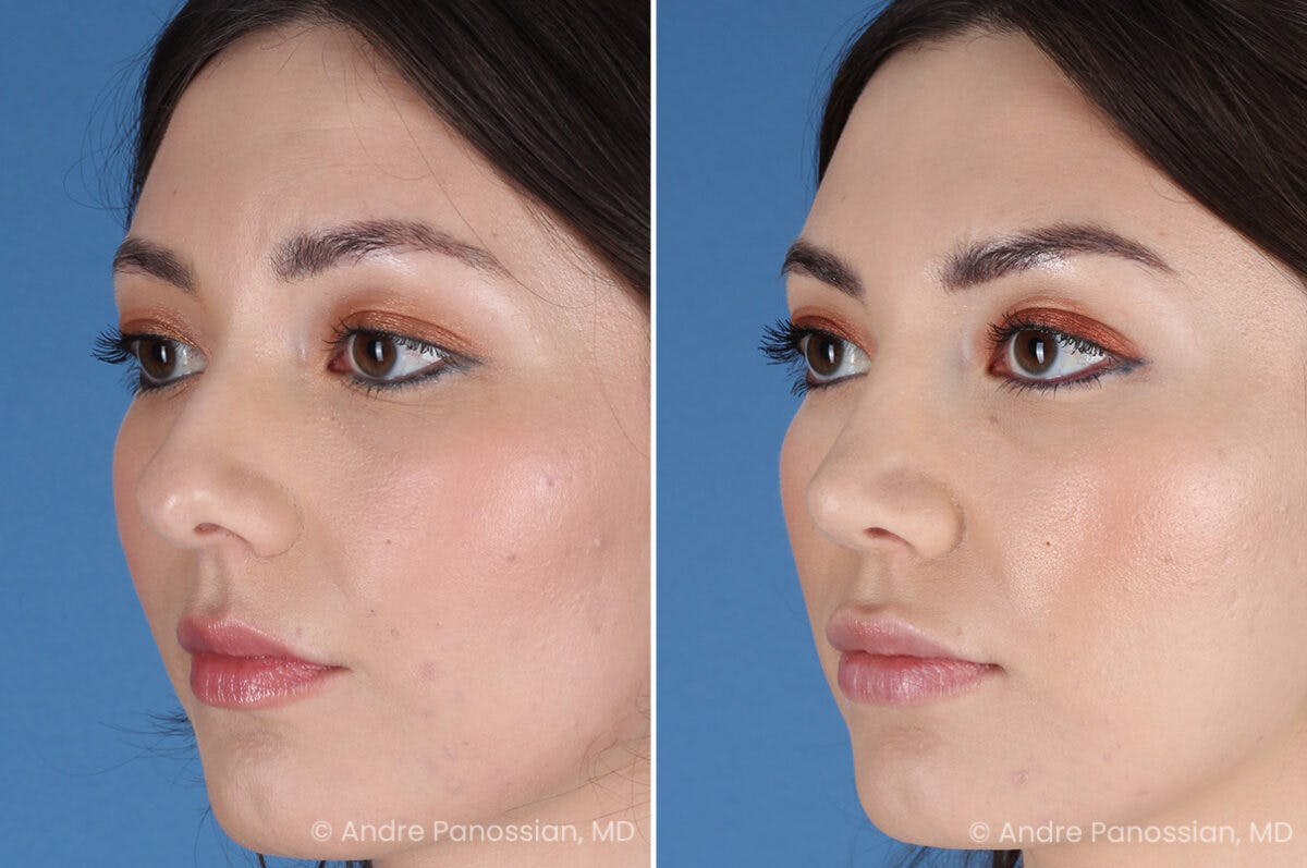 Rhinoplasty Before & After Gallery - Patient 257016 - Image 3