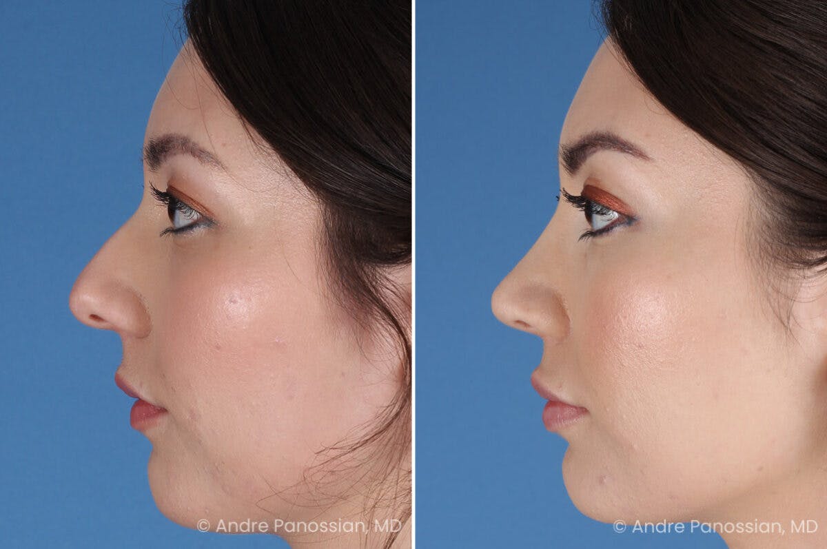 Rhinoplasty Before & After Gallery - Patient 257016 - Image 4