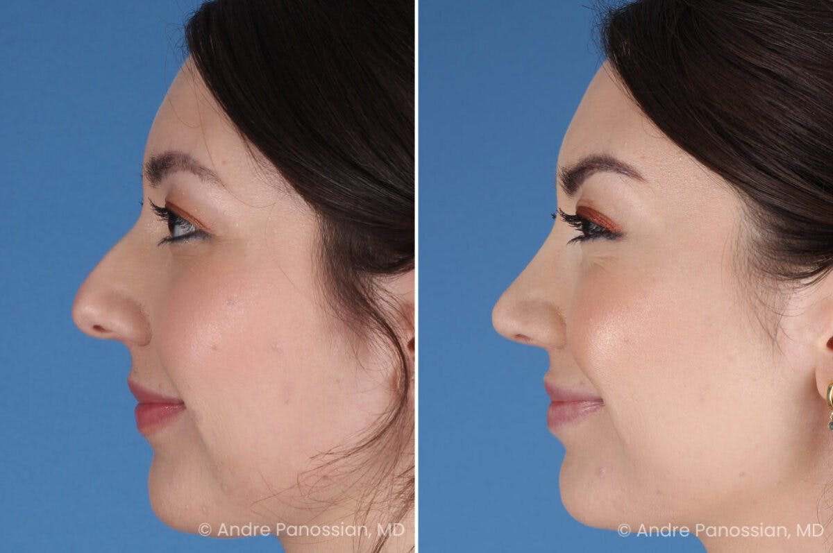 Rhinoplasty Before & After Gallery - Patient 257016 - Image 5