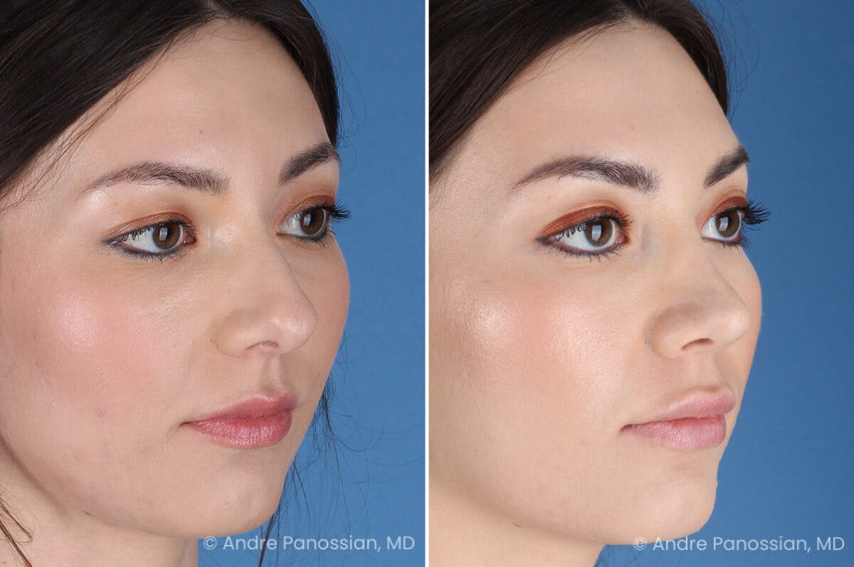 Rhinoplasty Before & After Gallery - Patient 257016 - Image 6