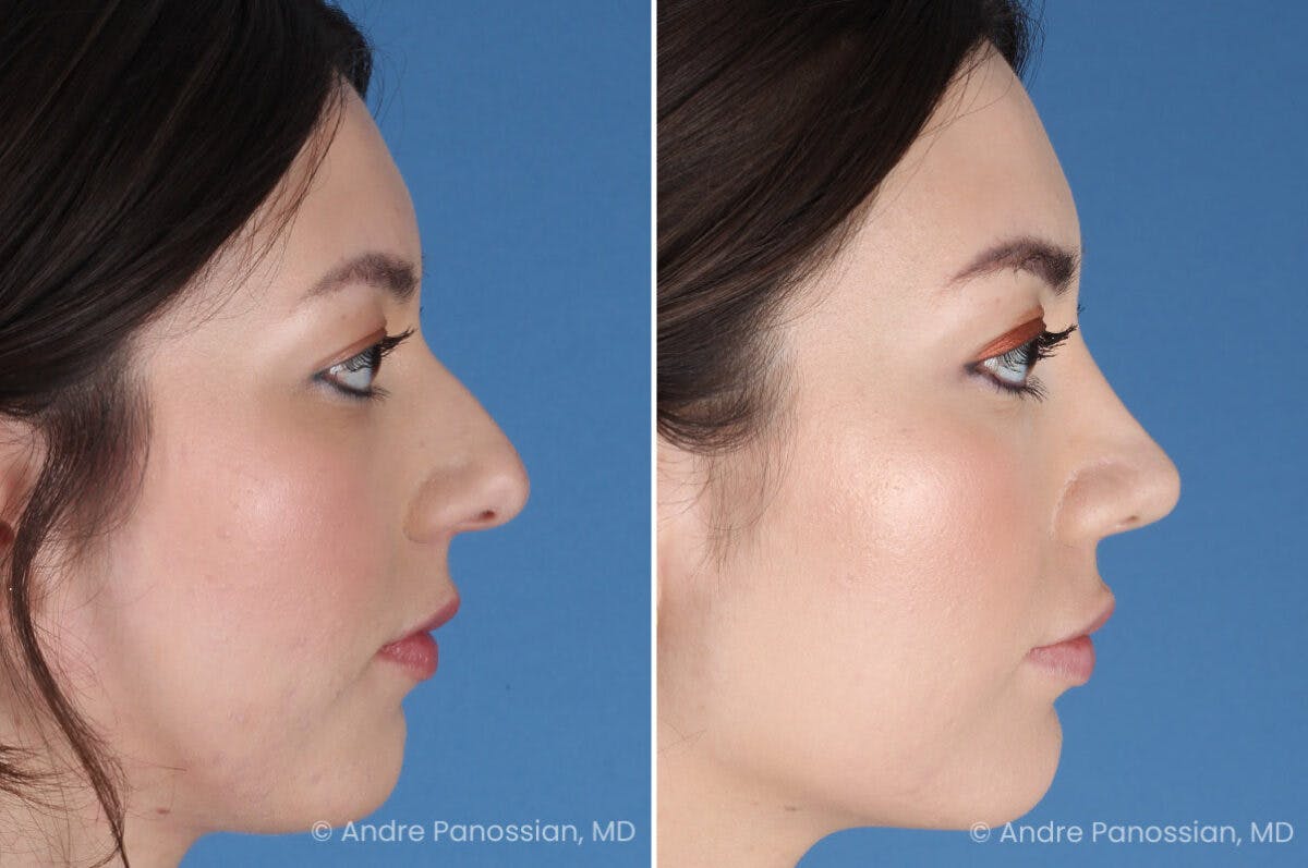 Rhinoplasty Before & After Gallery - Patient 257016 - Image 1