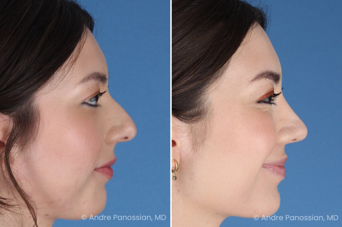 Rhinoplasty Before & After Gallery - Patient 257016 - Image 7