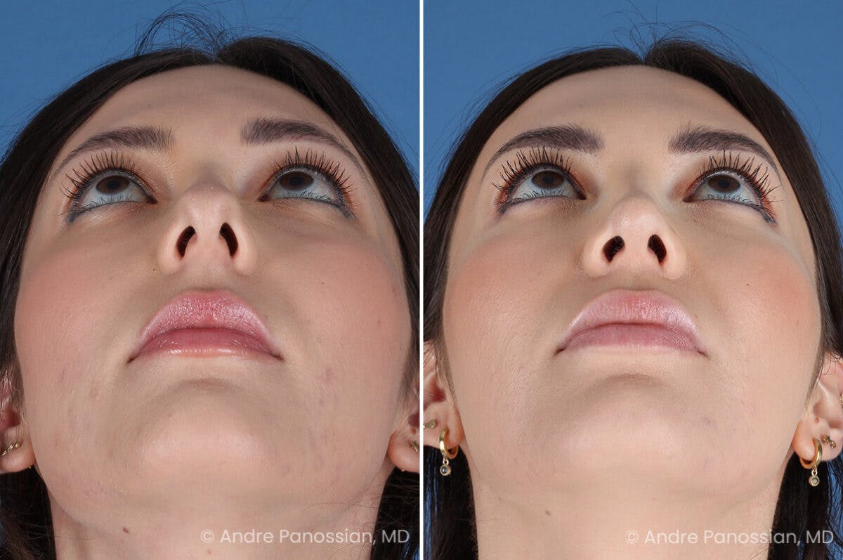 Rhinoplasty Before & After Gallery - Patient 257016 - Image 8