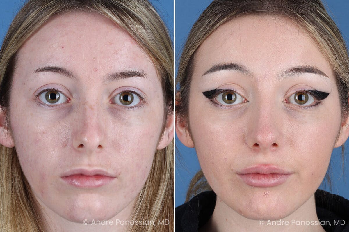 Rhinoplasty Before & After Gallery - Patient 176207 - Image 2