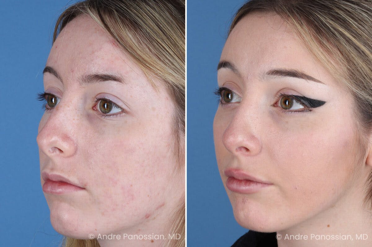 Rhinoplasty Before & After Gallery - Patient 176207 - Image 3