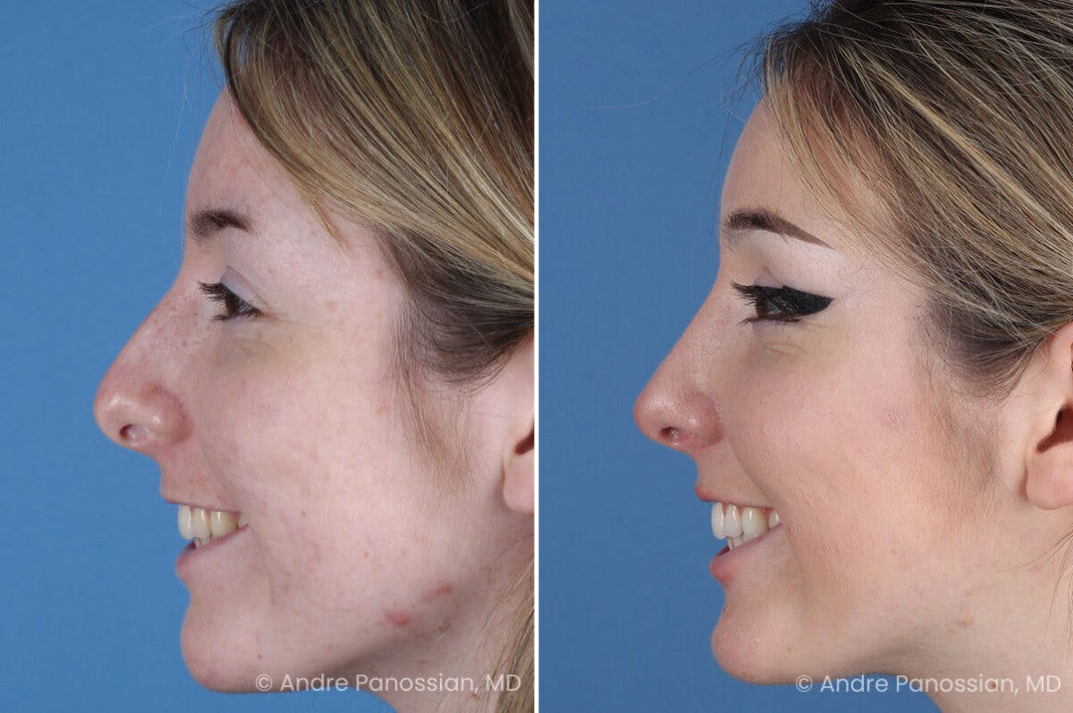 Rhinoplasty Before & After Gallery - Patient 176207 - Image 5