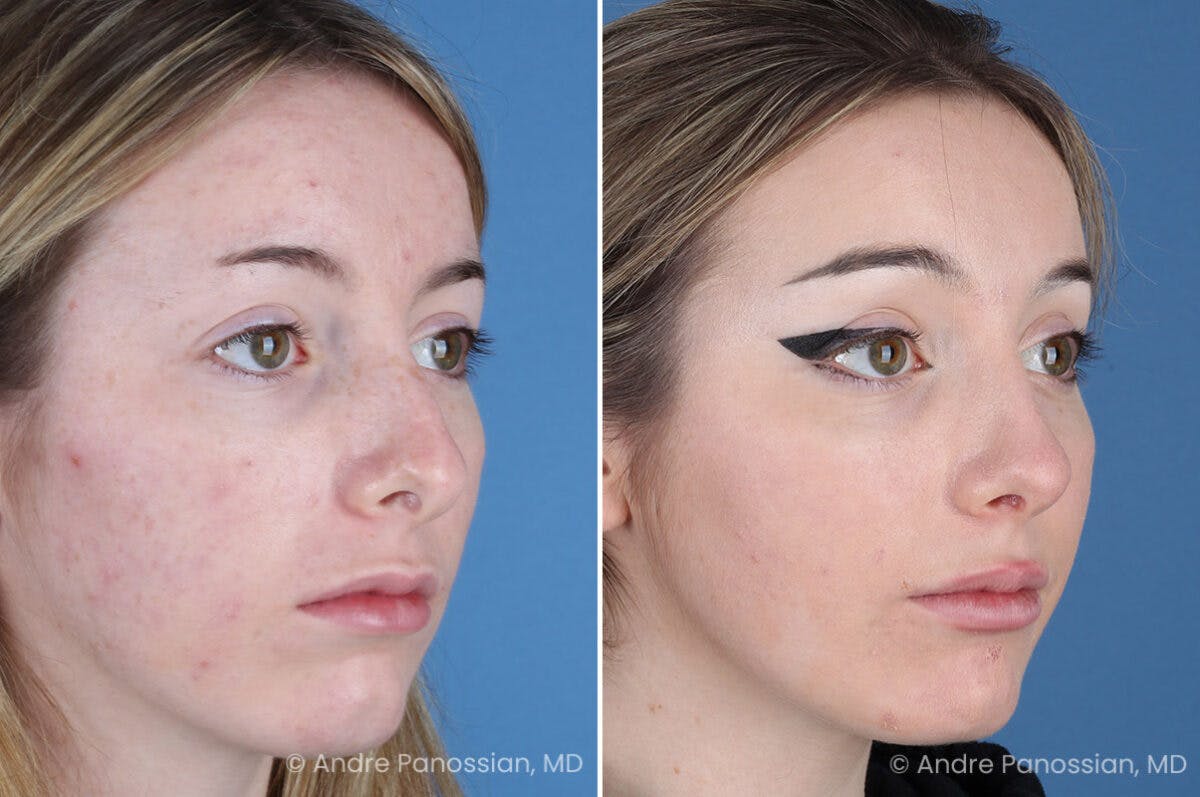 Rhinoplasty Before & After Gallery - Patient 176207 - Image 6
