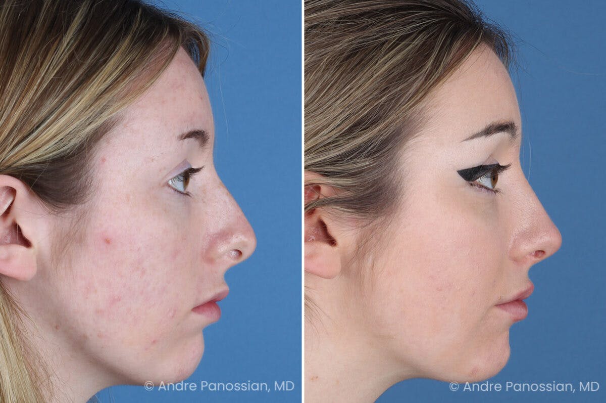 Rhinoplasty Before & After Gallery - Patient 176207 - Image 1