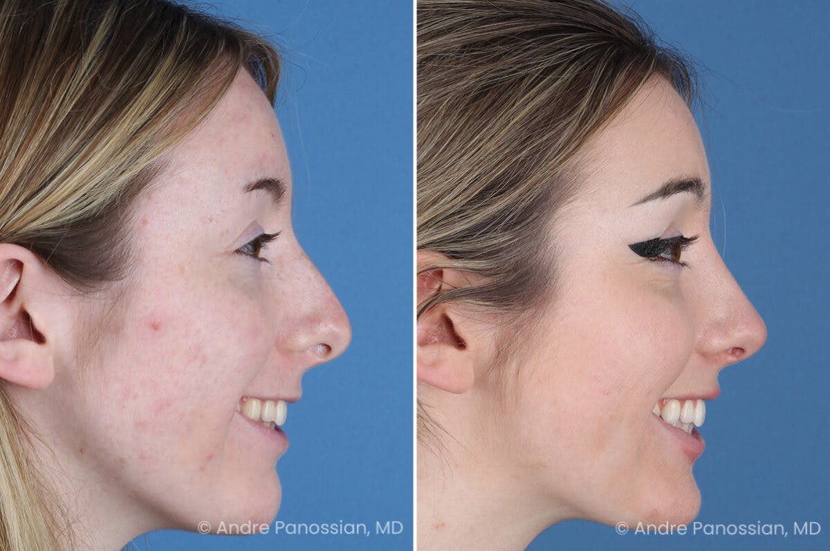 Rhinoplasty Before & After Gallery - Patient 176207 - Image 7