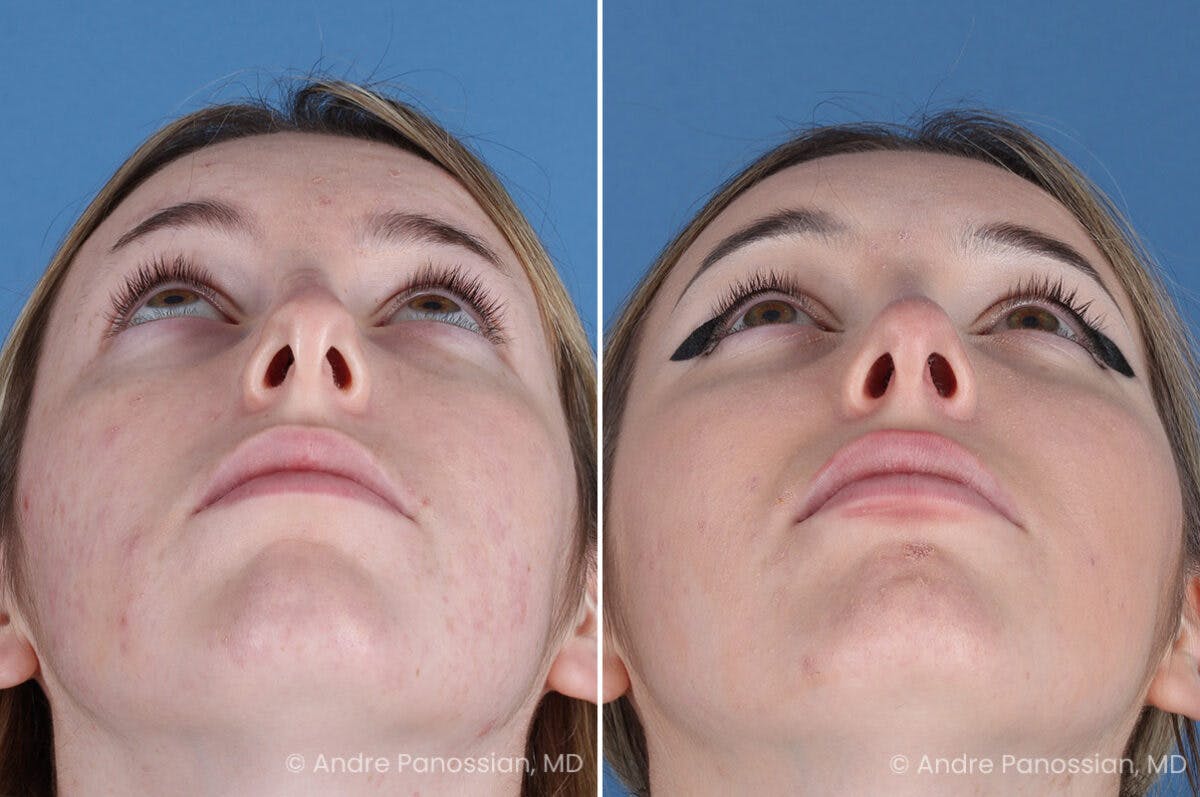 Rhinoplasty Before & After Gallery - Patient 176207 - Image 8