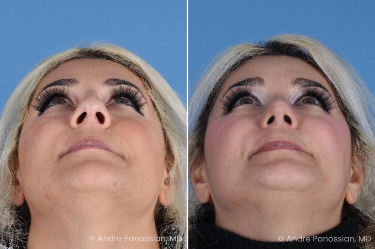 Rhinoplasty Before & After Gallery - Patient 912170 - Image 2