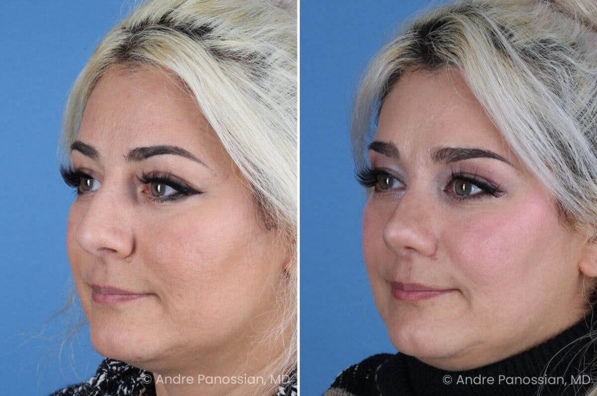 Rhinoplasty Before & After Gallery - Patient 912170 - Image 3